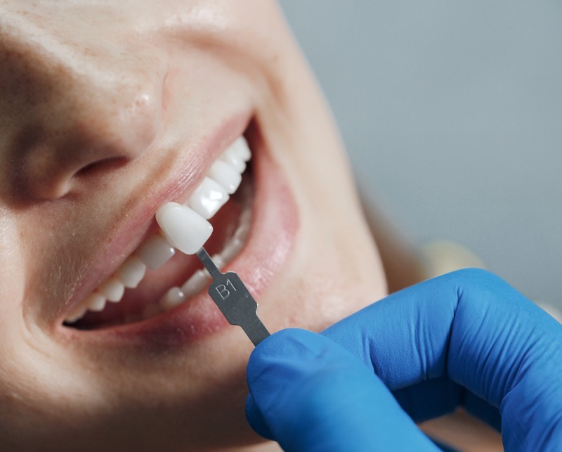 implantes-1